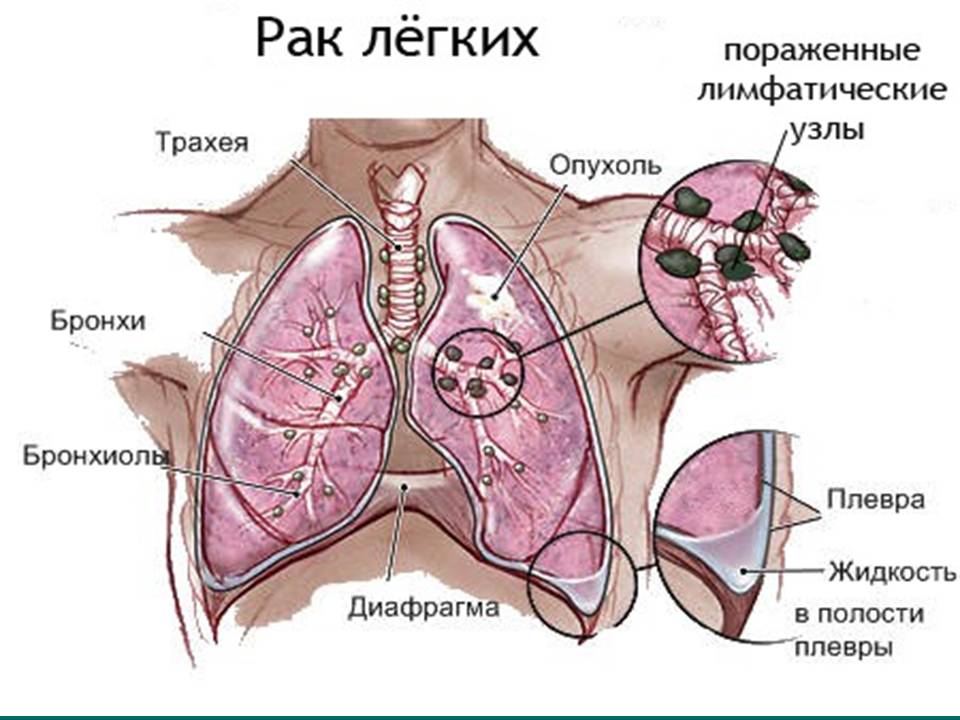 Рак легких на схеме