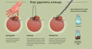 извлечение клеща методы извлечение клеща методы