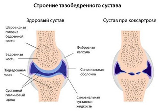 Коксартроз 