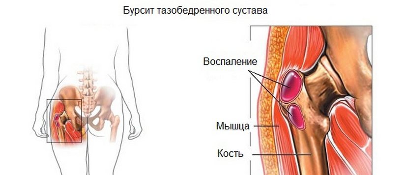 Бурсит тазобедренного сустава