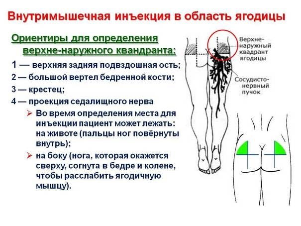 Внутримышечная инъекция в область ягодиц