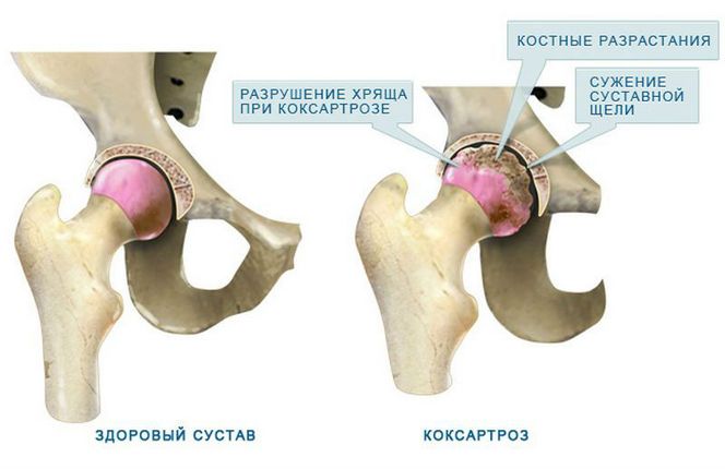 Коксартроз тазобедренного сустава